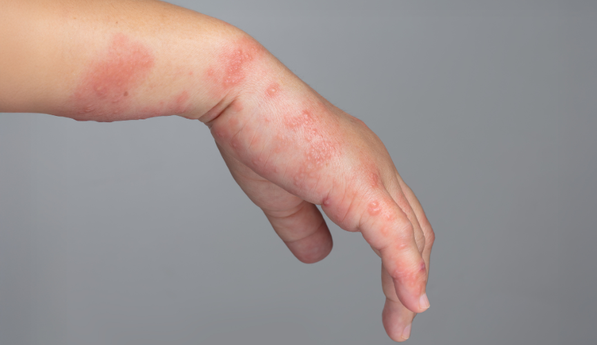 대상포진 이미지