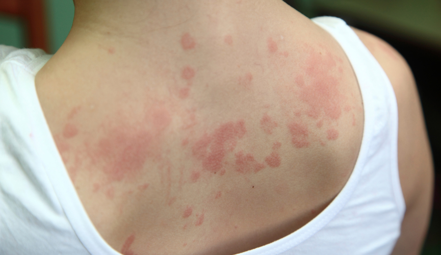 알러지성 피부염