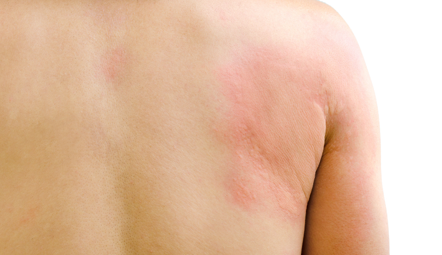 소아 음식 알레르기